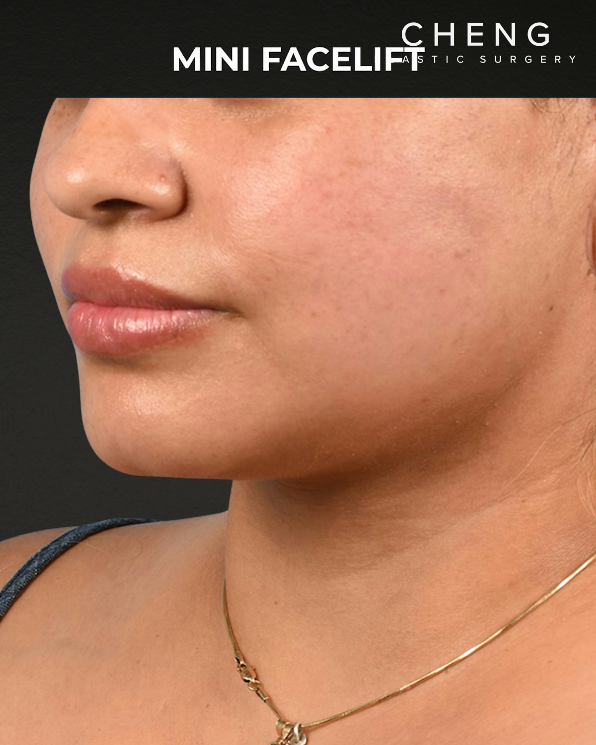 Facelift Before & After Gallery - Patient 508752 - Image 4