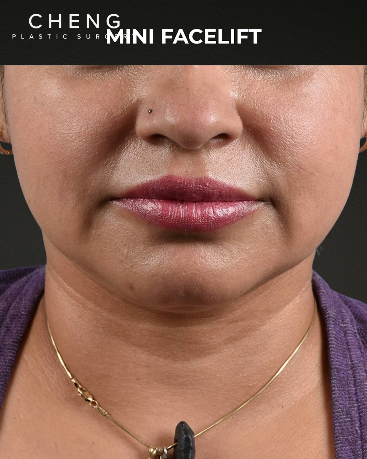 Facelift Before & After Gallery - Patient 508752 - Image 1