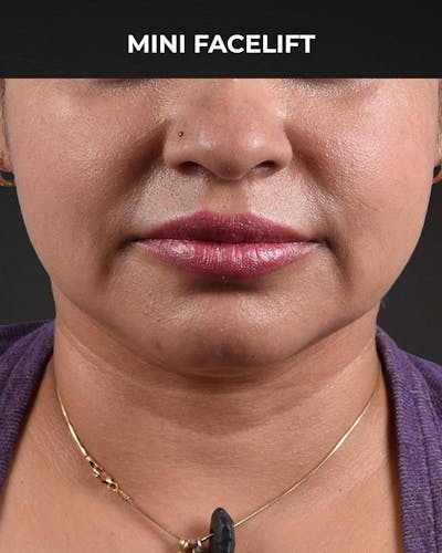 Facelift Before & After Gallery - Patient 508752 - Image 1