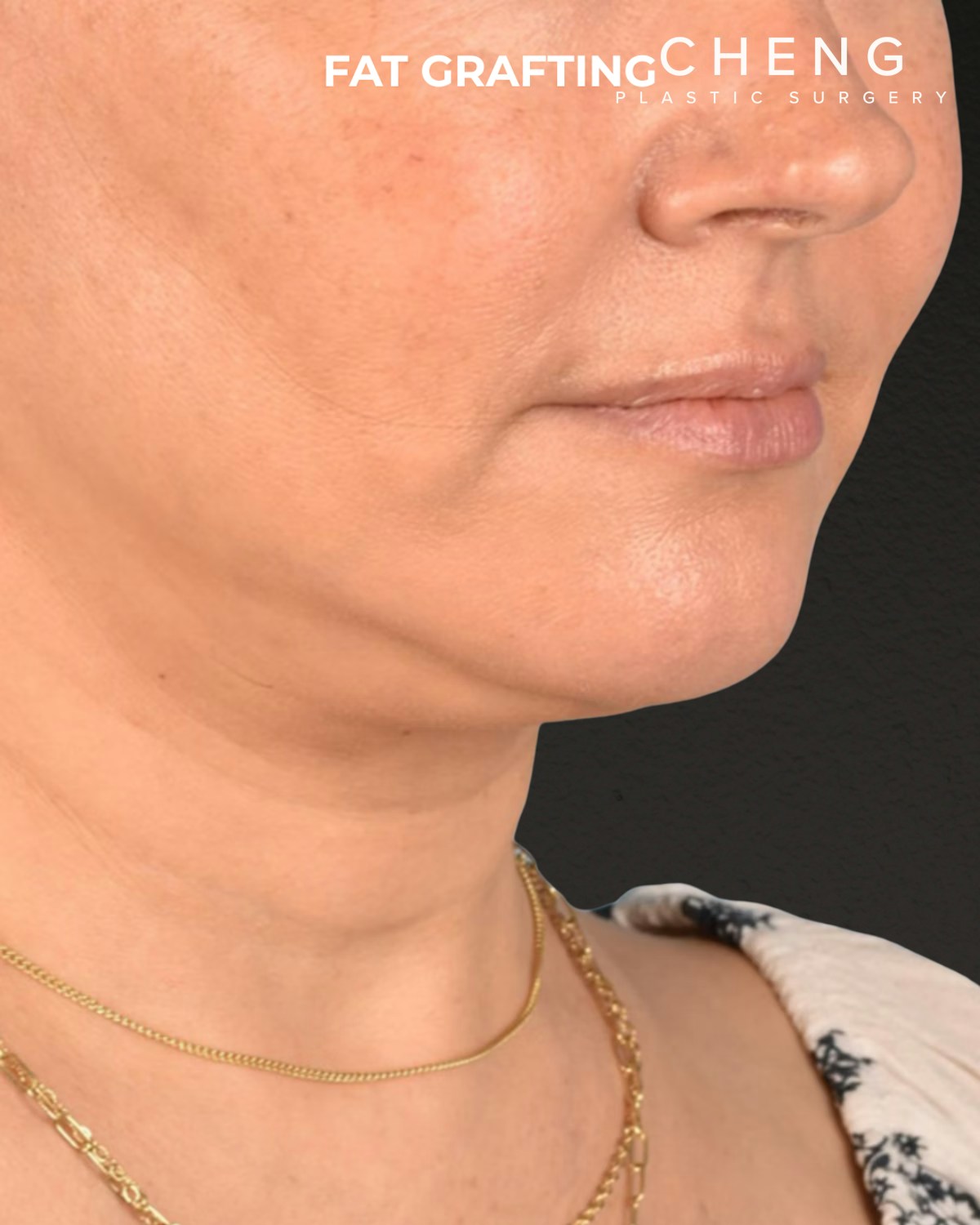 Fat Grafting Before & After Gallery - Patient 239537 - Image 4