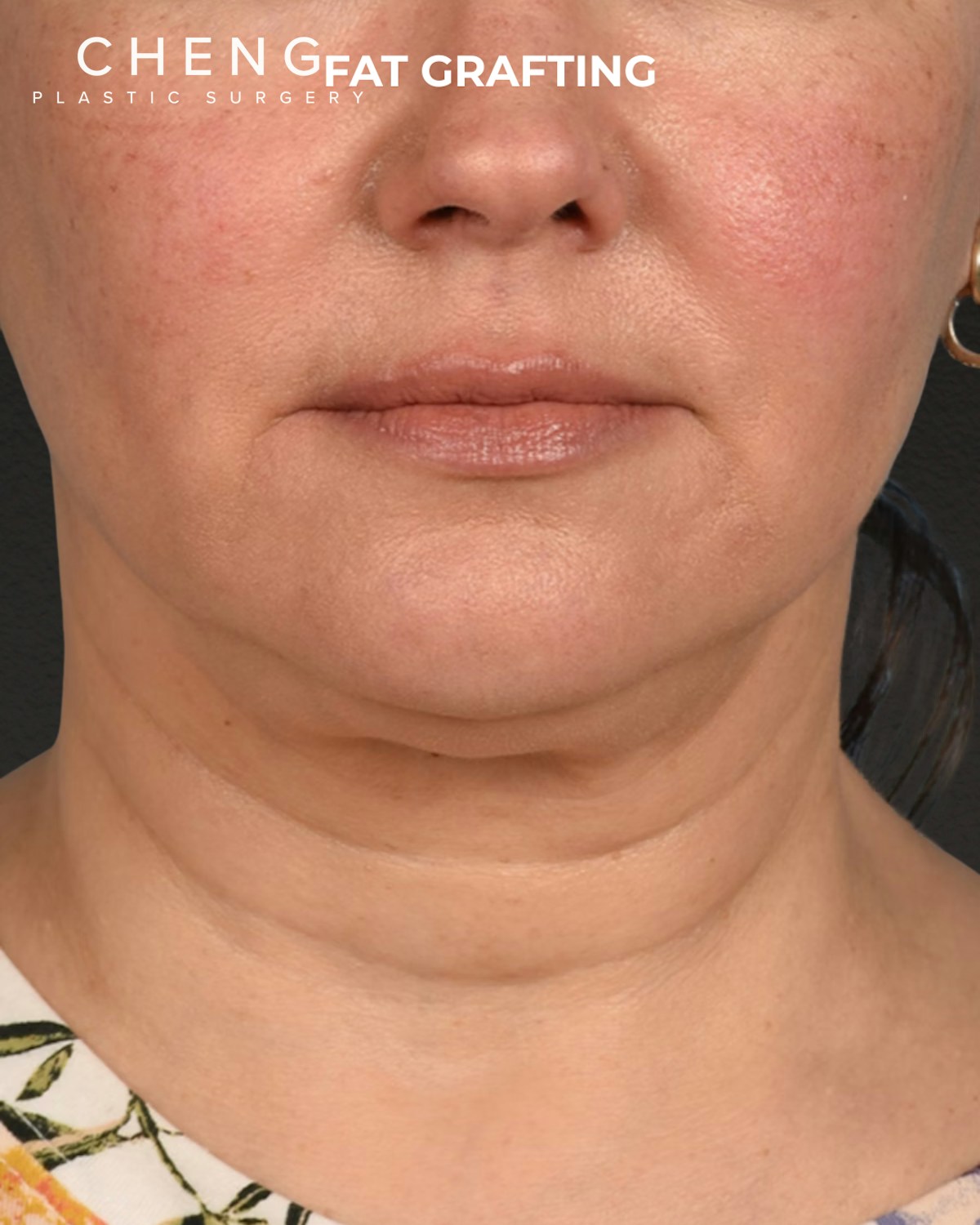 Fat Grafting Before & After Gallery - Patient 239537 - Image 1