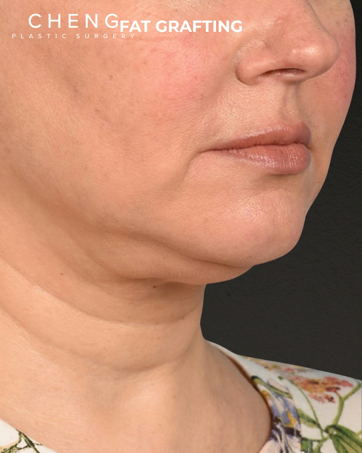 Fat Grafting Before & After Gallery - Patient 239537 - Image 3