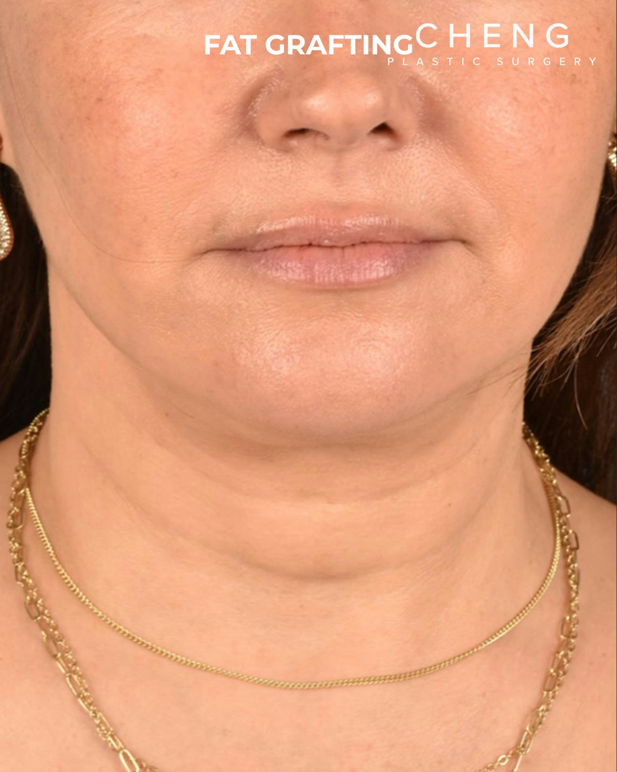 Fat Grafting Before & After Gallery - Patient 239537 - Image 2