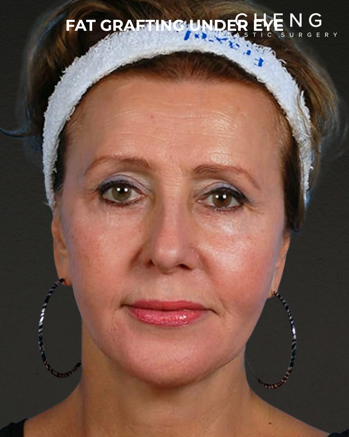 Fat Grafting Before & After Gallery - Patient 333366 - Image 2