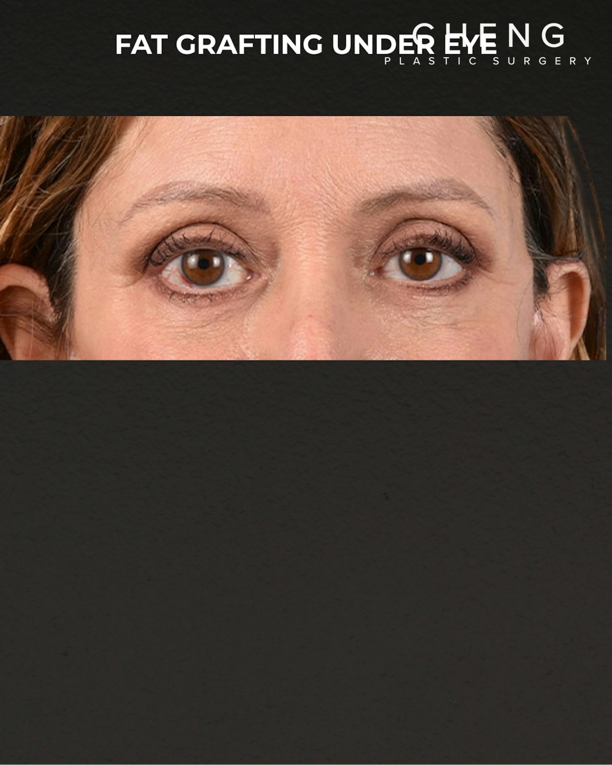 Fat Grafting Before & After Gallery - Patient 147269 - Image 2