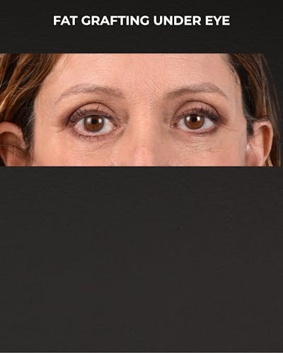 Fat Grafting Before & After Gallery - Patient 147269 - Image 2