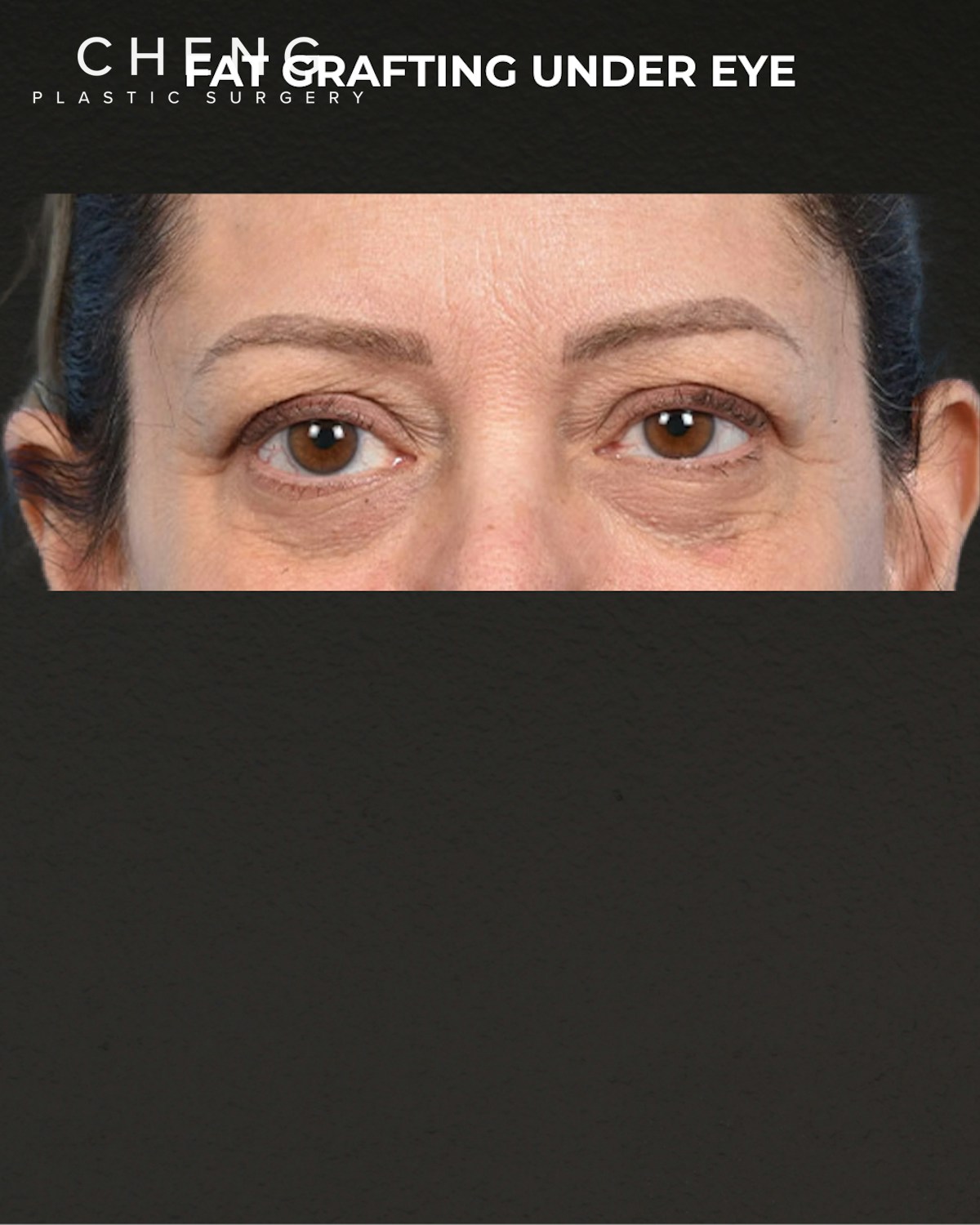 Fat Grafting Before & After Gallery - Patient 147269 - Image 1