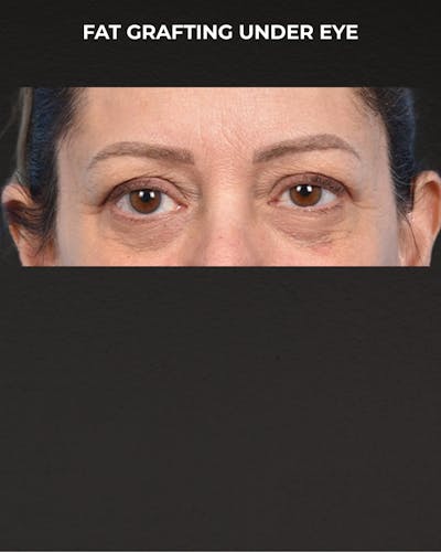 Fat Grafting Before & After Gallery - Patient 147269 - Image 1