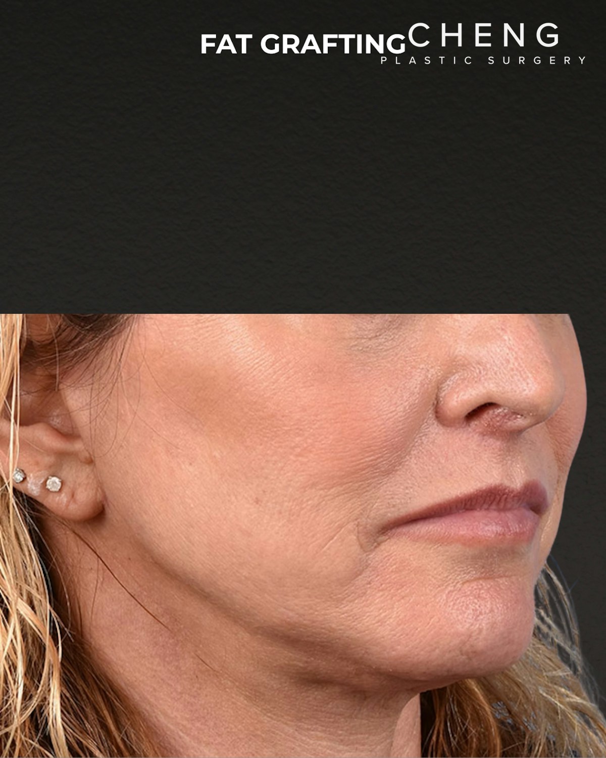 Fat Grafting Before & After Gallery - Patient 307741 - Image 6