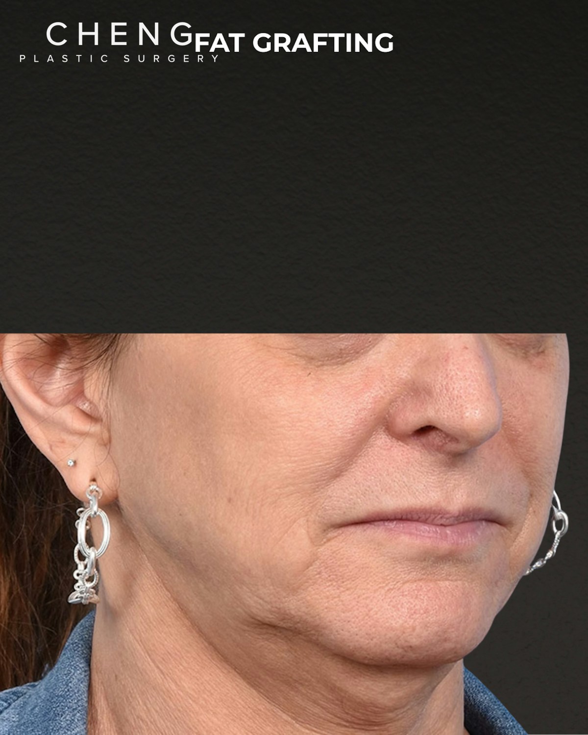Fat Grafting Before & After Gallery - Patient 307741 - Image 5