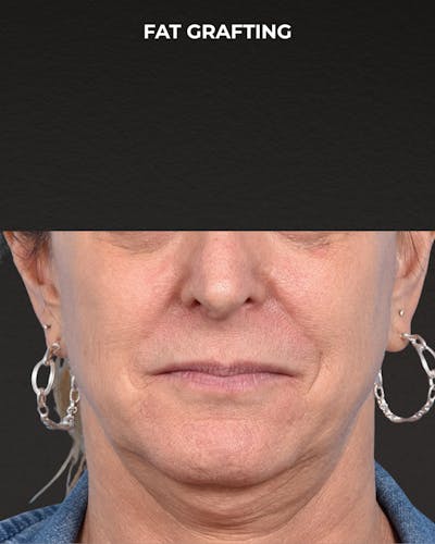 Fat Grafting Before & After Gallery - Patient 307741 - Image 1
