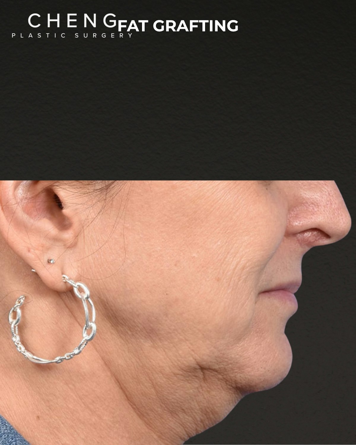 Fat Grafting Before & After Gallery - Patient 307741 - Image 3