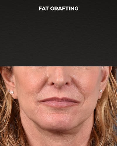 Fat Grafting Before & After Gallery - Patient 307741 - Image 2