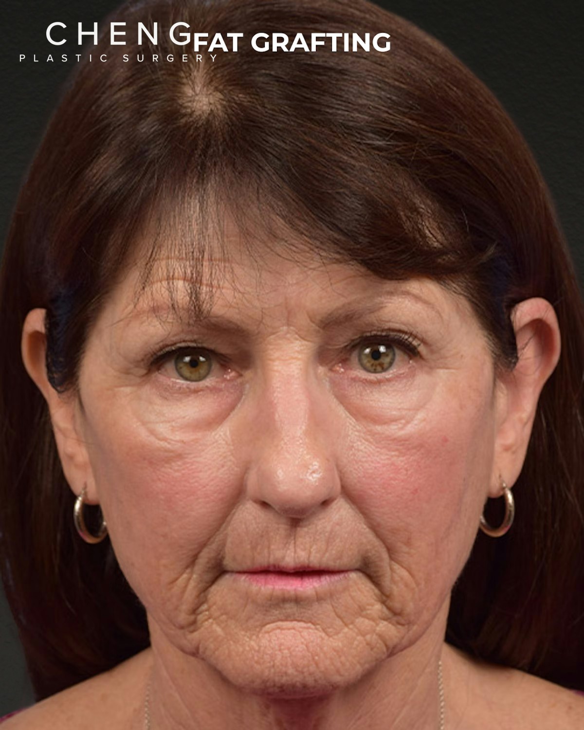 Fat Grafting Before & After Gallery - Patient 364651 - Image 1