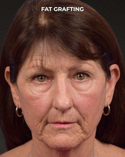 Fat Grafting Before & After Gallery - Patient 364651 - Image 1