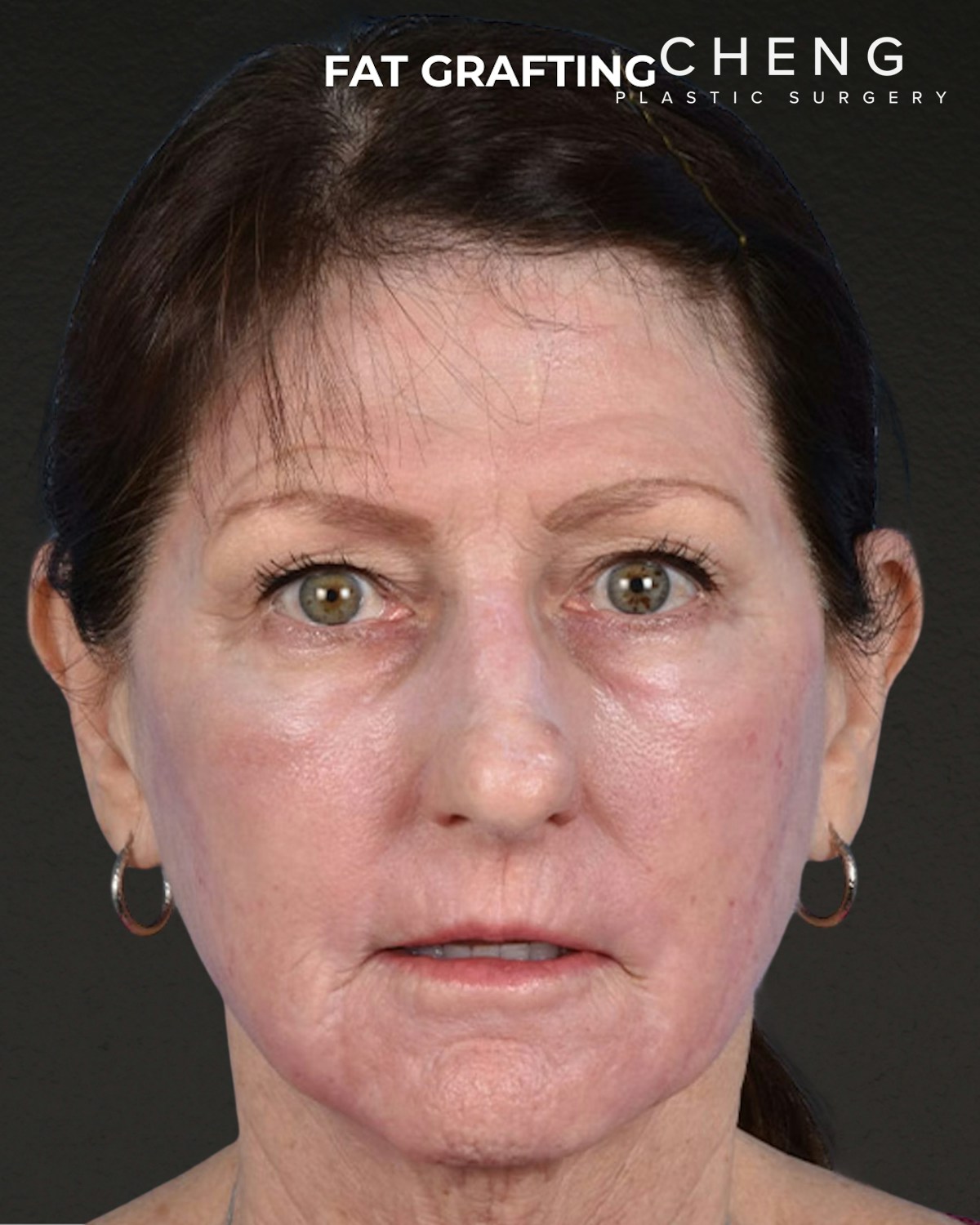 Fat Grafting Before & After Gallery - Patient 364651 - Image 2