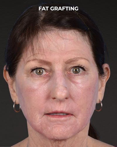 Fat Grafting Before & After Gallery - Patient 364651 - Image 2