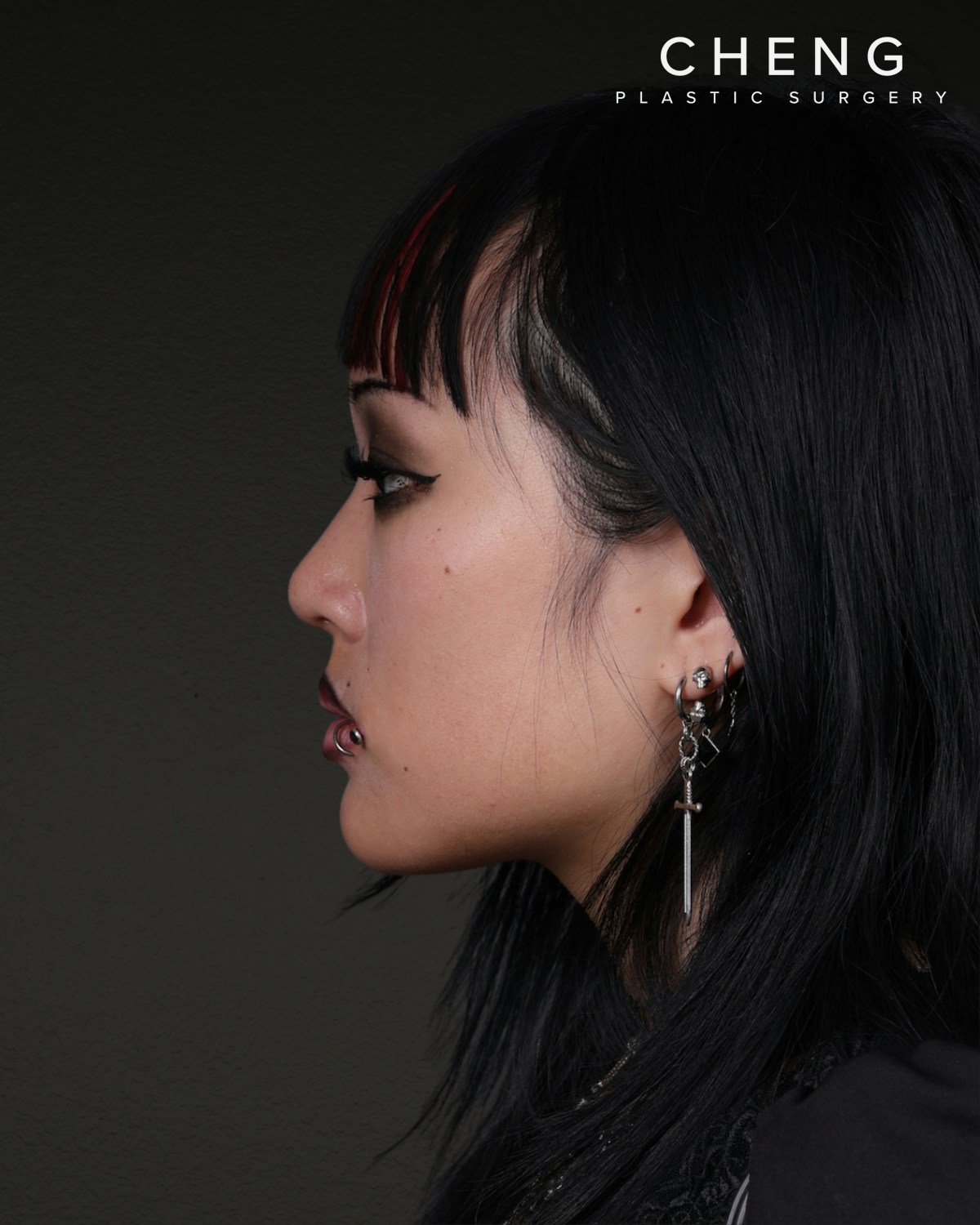 Rhinoplasty Before & After Gallery - Patient 113225 - Image 4