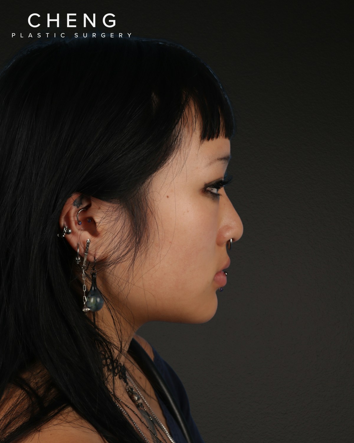 Rhinoplasty Before & After Gallery - Patient 113225 - Image 1