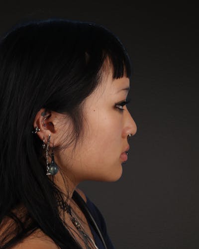 Rhinoplasty Before & After Gallery - Patient 113225 - Image 1