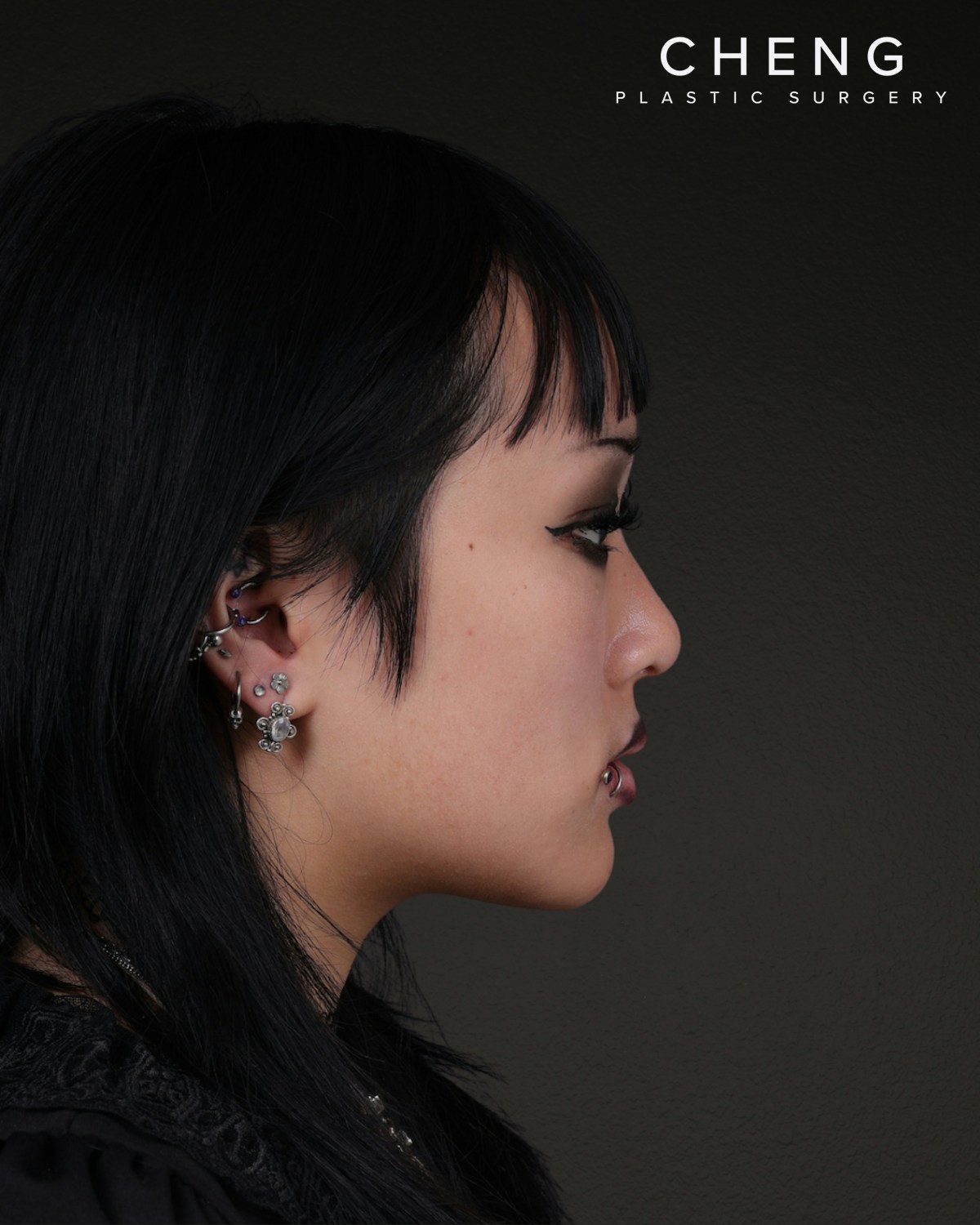 Rhinoplasty Before & After Gallery - Patient 113225 - Image 2