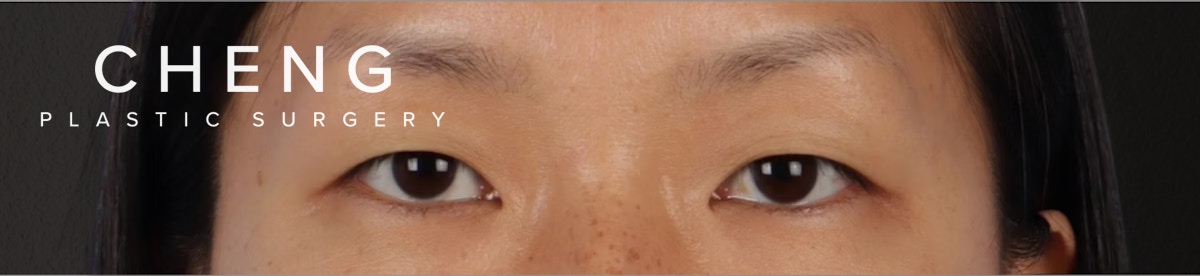 Blepharoplasty Before & After Gallery - Patient 871559 - Image 1