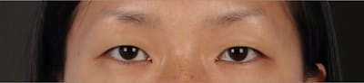 Blepharoplasty Before & After Gallery - Patient 871559 - Image 1