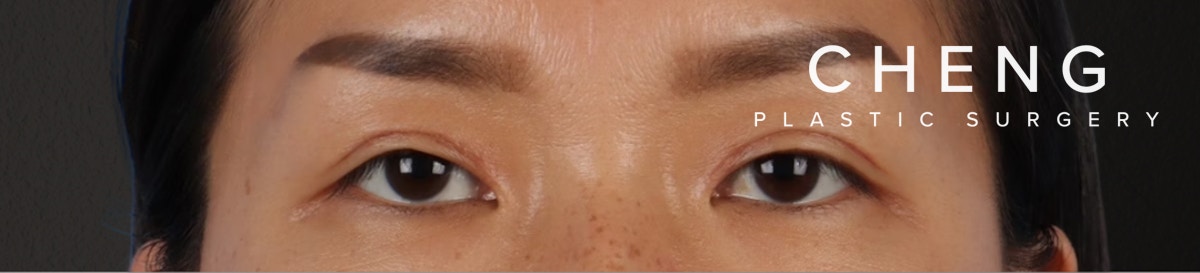 Blepharoplasty Before & After Gallery - Patient 871559 - Image 2