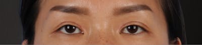 Blepharoplasty Before & After Gallery - Patient 871559 - Image 2
