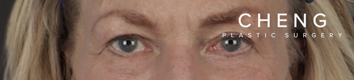Blepharoplasty Before & After Gallery - Patient 912260 - Image 2