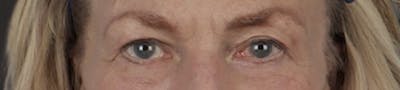 Blepharoplasty Before & After Gallery - Patient 912260 - Image 2
