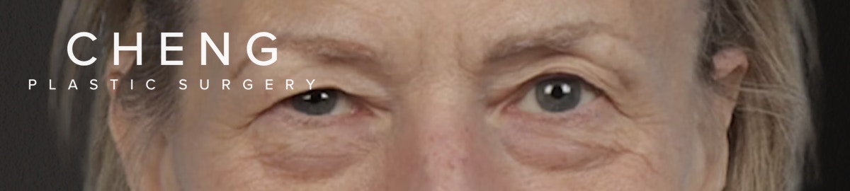 Blepharoplasty Before & After Gallery - Patient 912260 - Image 1