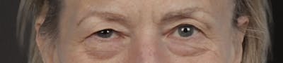 Blepharoplasty Before & After Gallery - Patient 912260 - Image 1