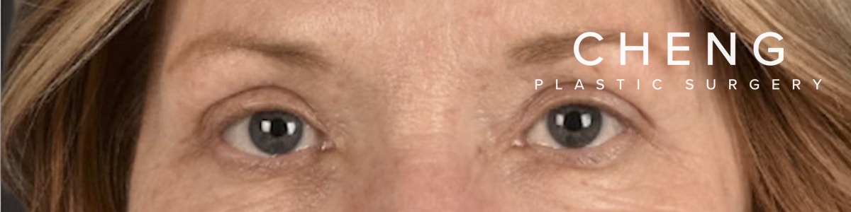 Blepharoplasty Before & After Gallery - Patient 943759 - Image 2