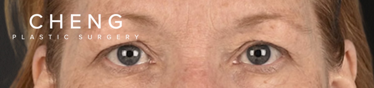 Blepharoplasty Before & After Gallery - Patient 943759 - Image 1