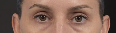 Blepharoplasty Before & After Gallery - Patient 117445 - Image 1