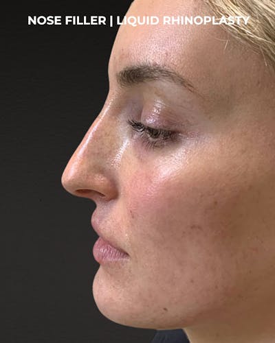 Dermal Fillers Before & After Gallery - Patient 318758 - Image 2