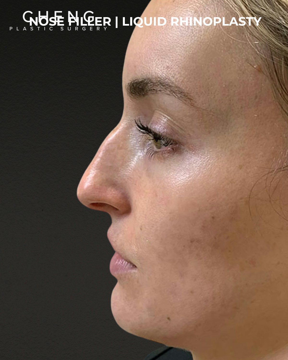 Dermal Fillers Before & After Gallery - Patient 318758 - Image 1