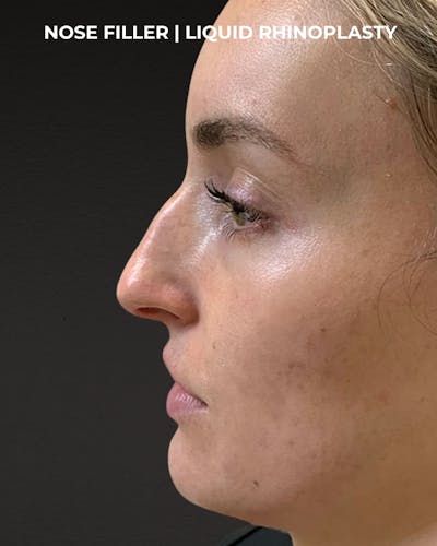 Dermal Fillers Before & After Gallery - Patient 318758 - Image 1