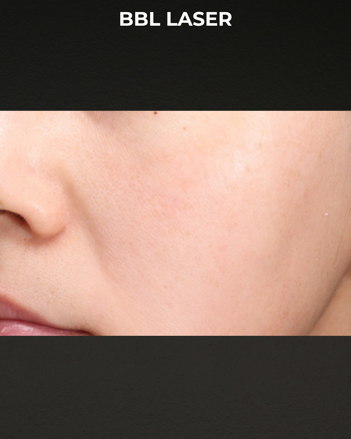 Pigment Laser Before & After Gallery - Patient 260727 - Image 4