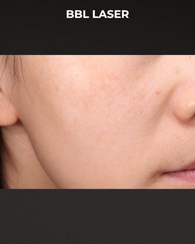 Pigment Laser Before & After Gallery - Patient 260727 - Image 1