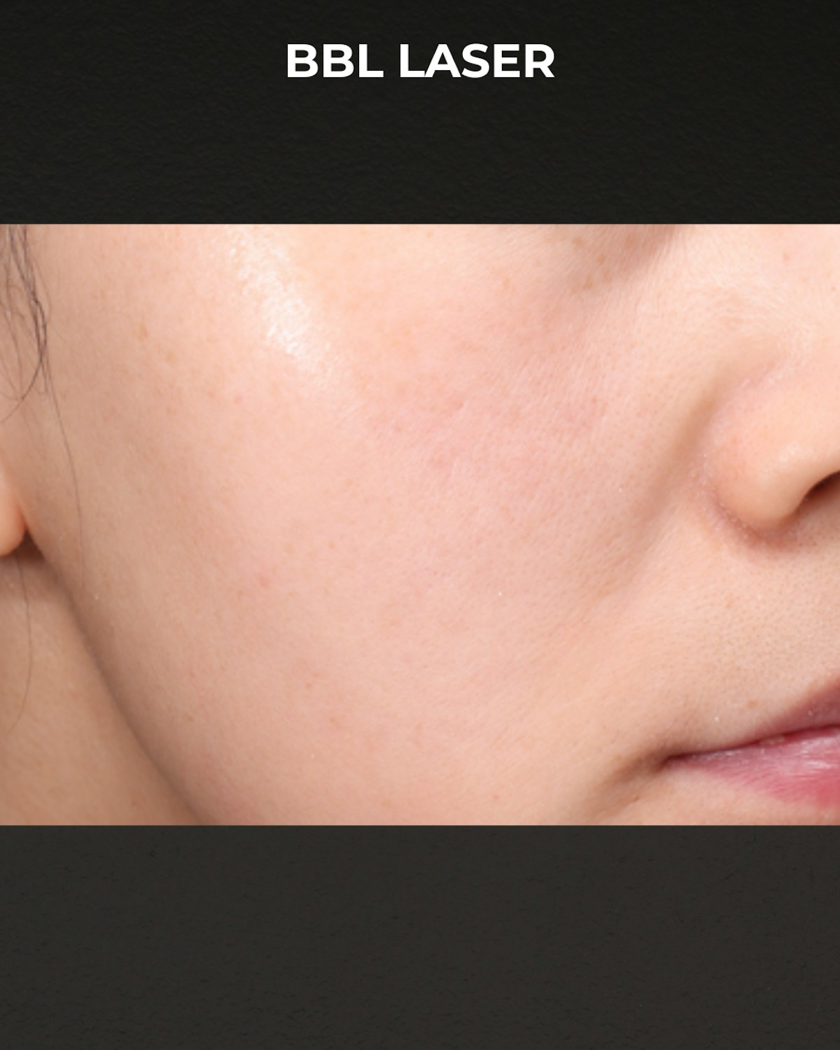 Pigment Laser Before & After Gallery - Patient 260727 - Image 2