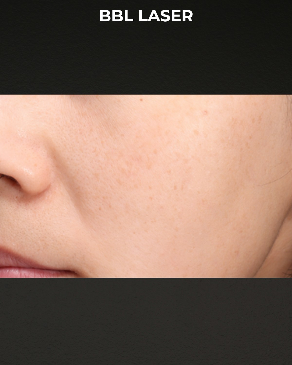 Pigment Laser Before & After Gallery - Patient 260727 - Image 3