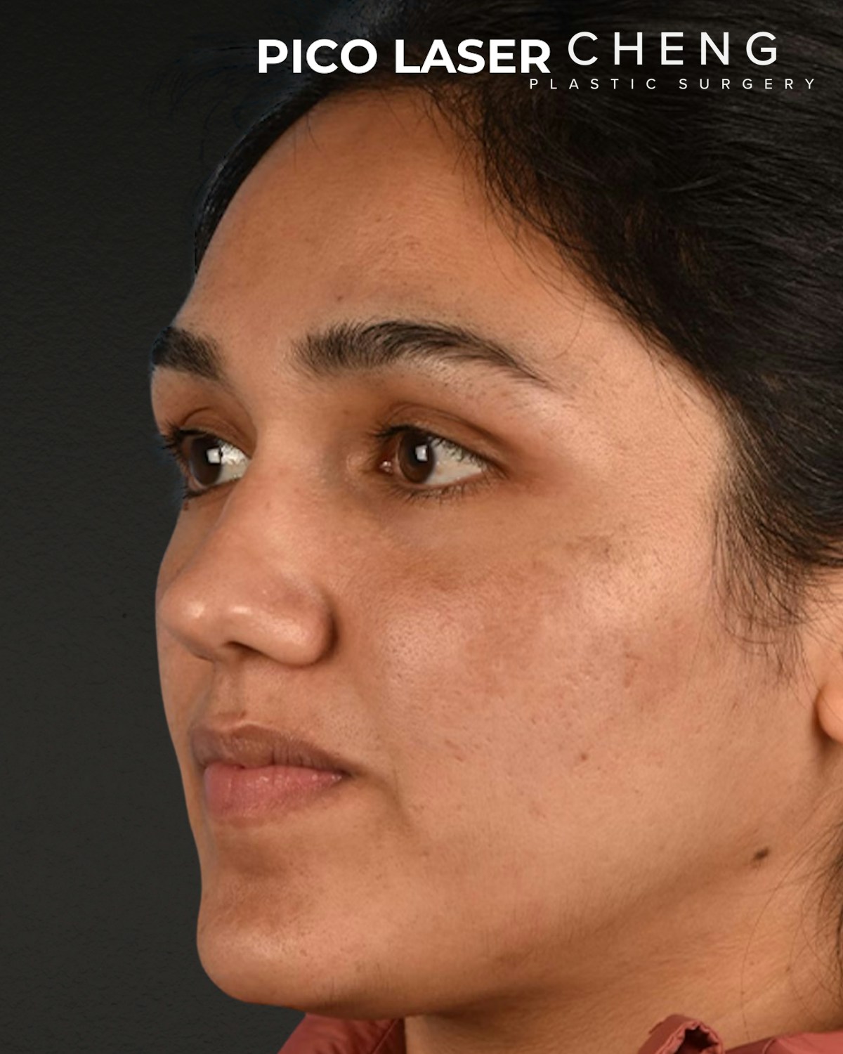Pigment Laser Before & After Gallery - Patient 304638 - Image 4