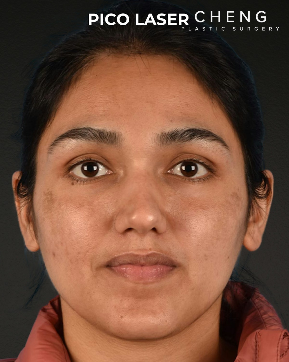 Pigment Laser Before & After Gallery - Patient 304638 - Image 2