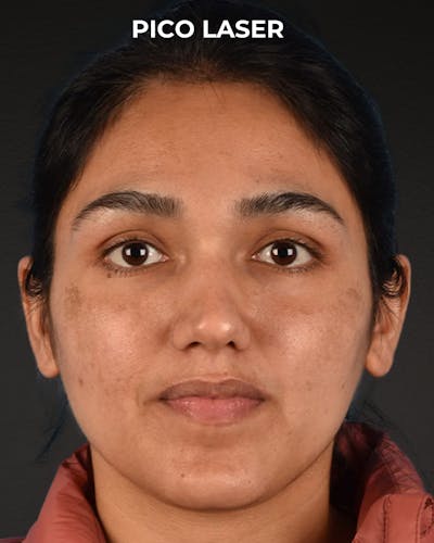 Pigment Laser Before & After Gallery - Patient 304638 - Image 2