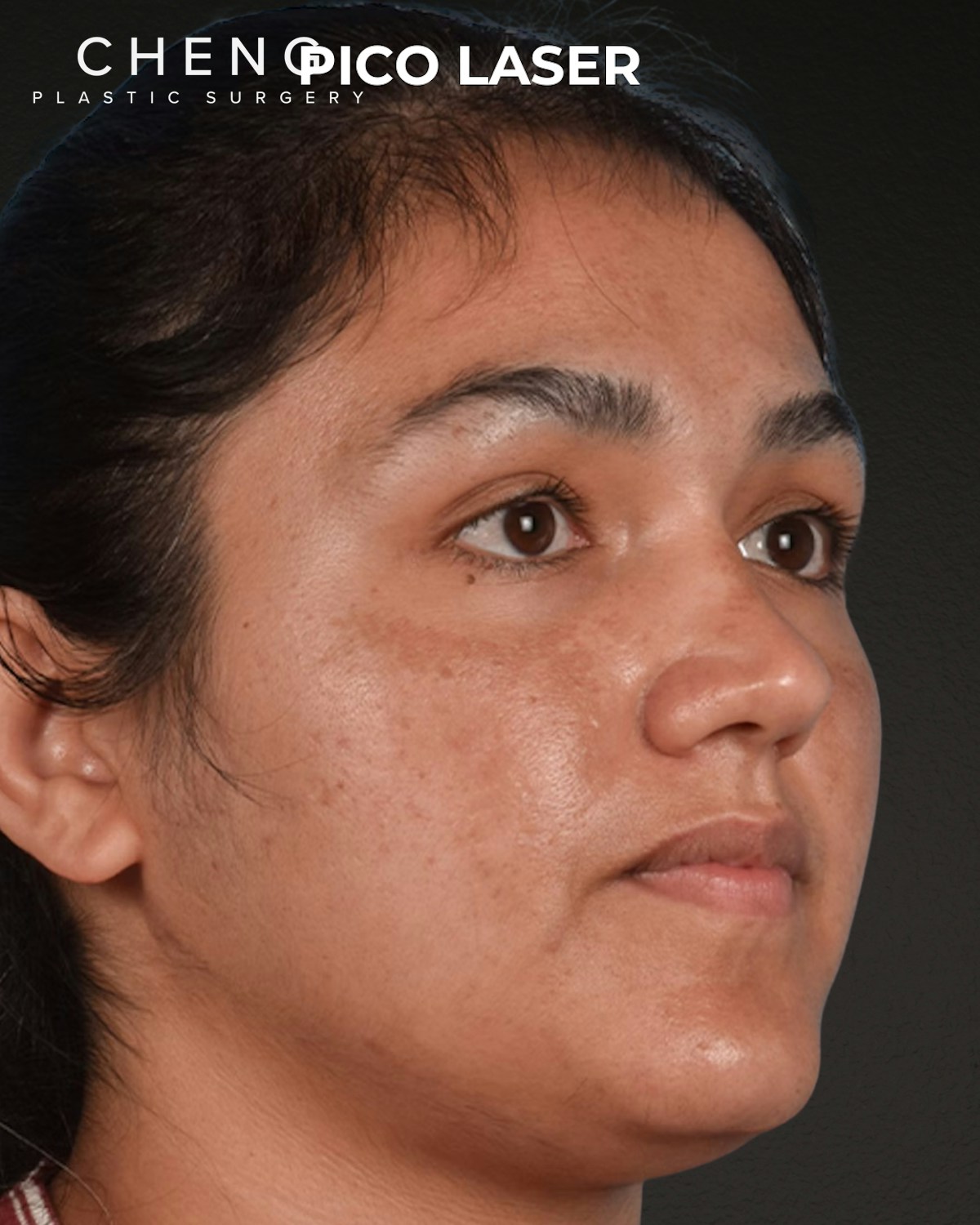Pigment Laser Before & After Gallery - Patient 304638 - Image 5