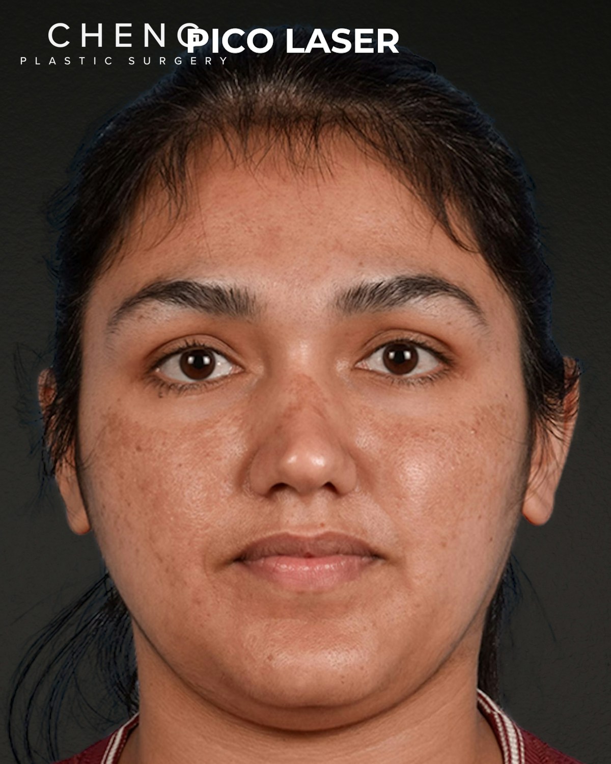 Pigment Laser Before & After Gallery - Patient 304638 - Image 1