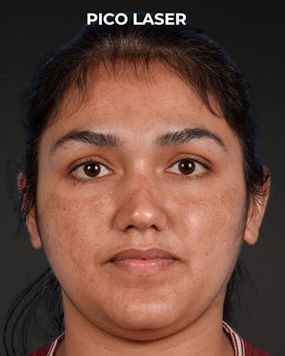 Pigment Laser Before & After Gallery - Patient 304638 - Image 1