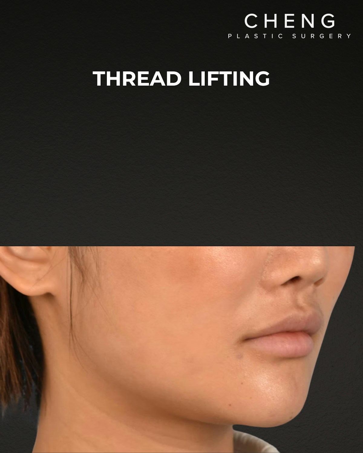 Thread Lifting Before & After Gallery - Patient 132694 - Image 4